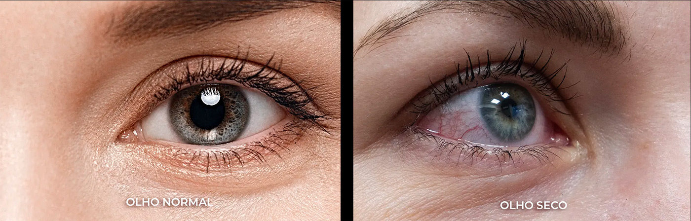 A Síndrome do Olho Seco é uma anomalia na produção das lágrima ou até mesmo na sua qualidade, podendo desencadear o ressecamento, infecção ou inflamação na superfície do olho.