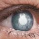 Abril Marrom é um alerta sobre doenças que podem levar à cegueira.